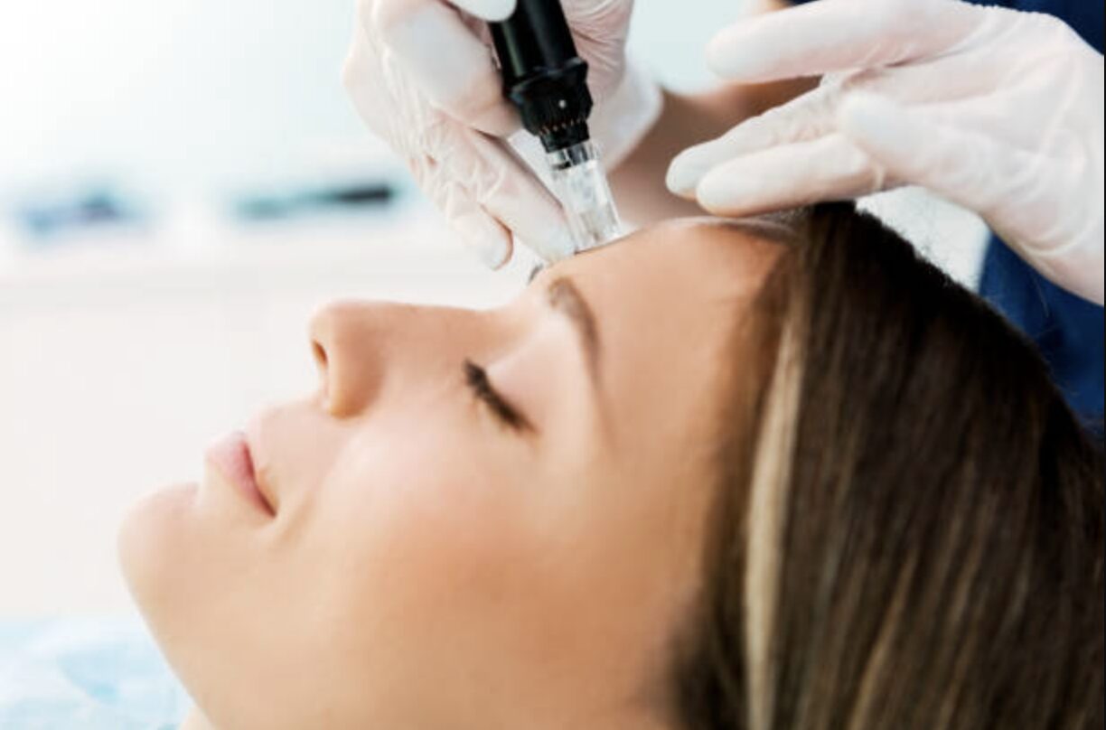 micro needling on face