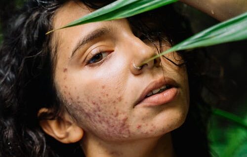 Fungal acne