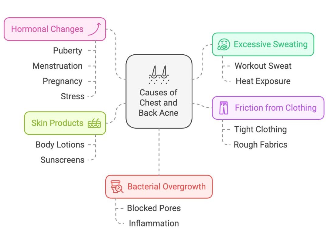 Causes of Chest and Back Acne